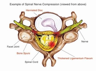 Example of Spinal Nerve Compression